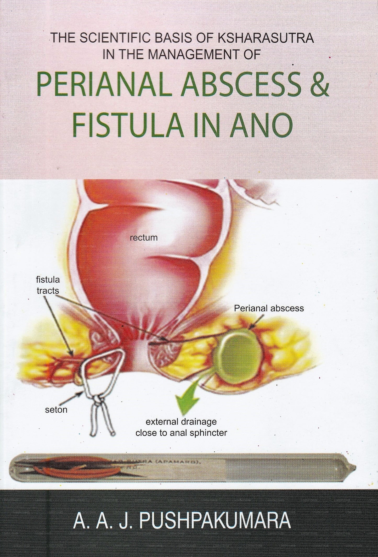 肛門周囲膿瘍および肛門周囲膿瘍の管理におけるクシャラスートラの科学的根拠アノの瘻孔
